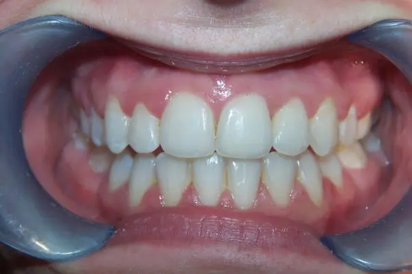 after braces