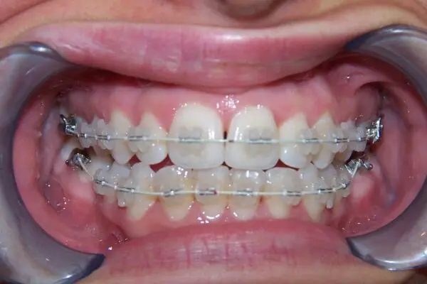 with braces